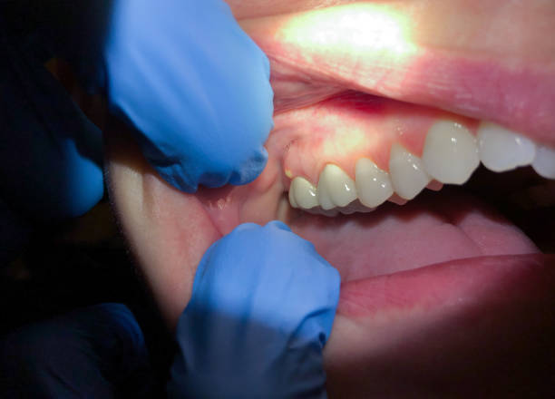 Best Dentist for Tooth Abscess  in Curtisville, PA